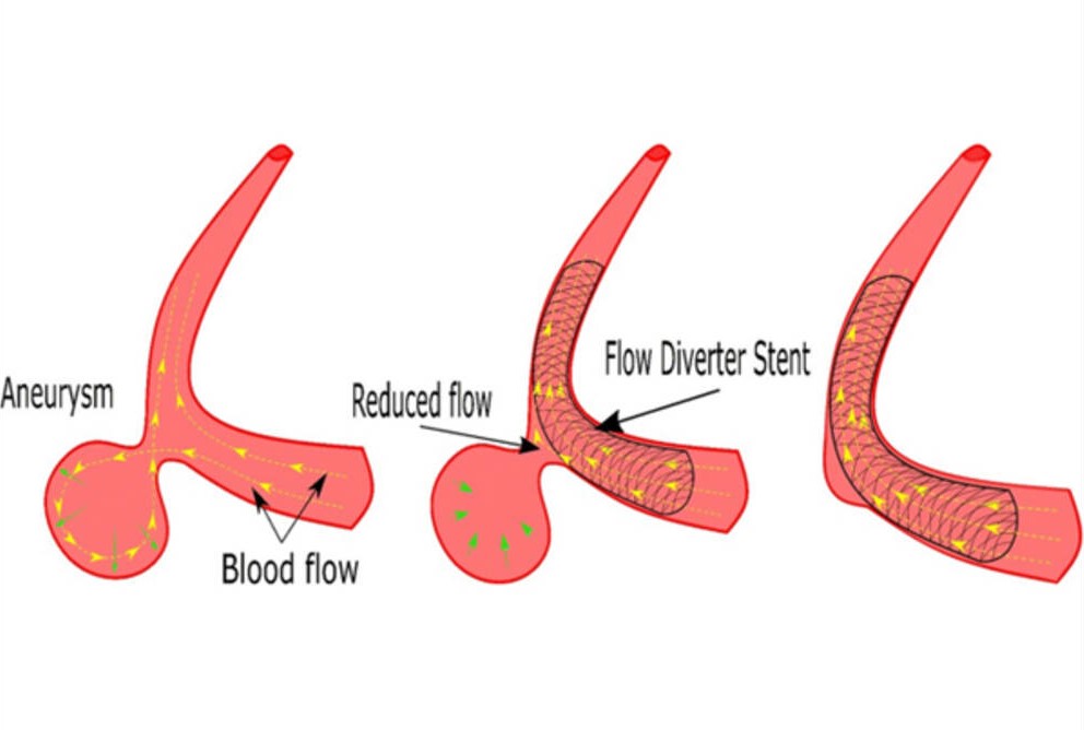 Benefits of Flow Diverter Placement