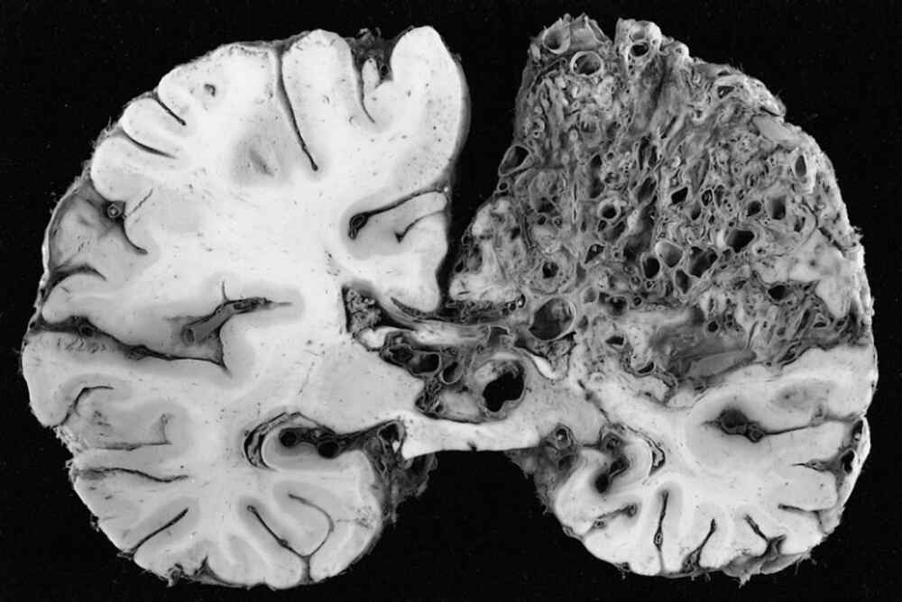 Brain AVM Types and Urgent Red Flags