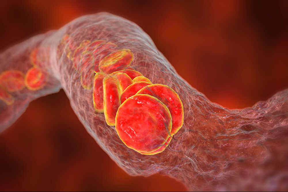 Causes and Risk Factors for SAH Vasospasm