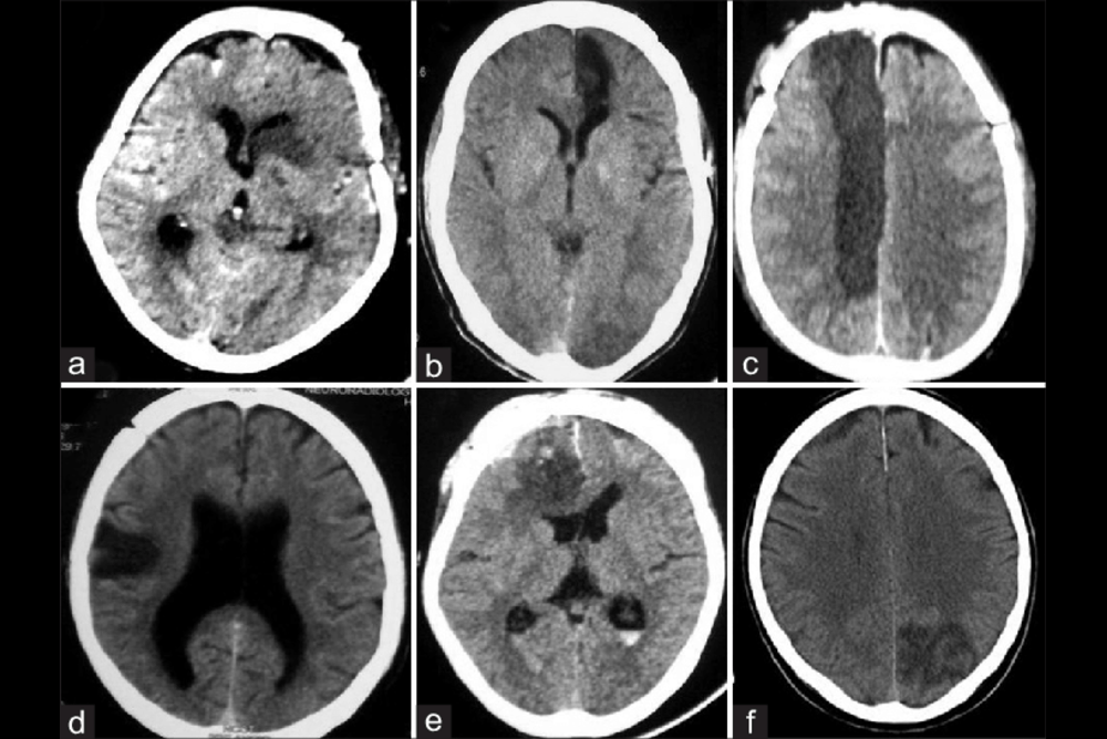 Diagnosis of SAH Vasospasm
