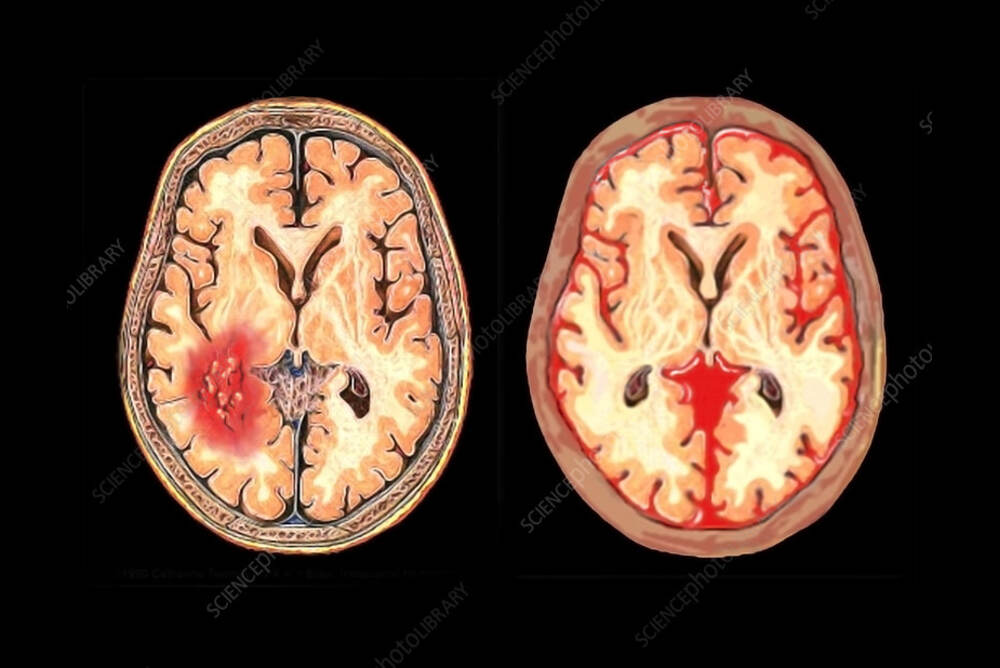 Management and Treatment Options for Vasospasm