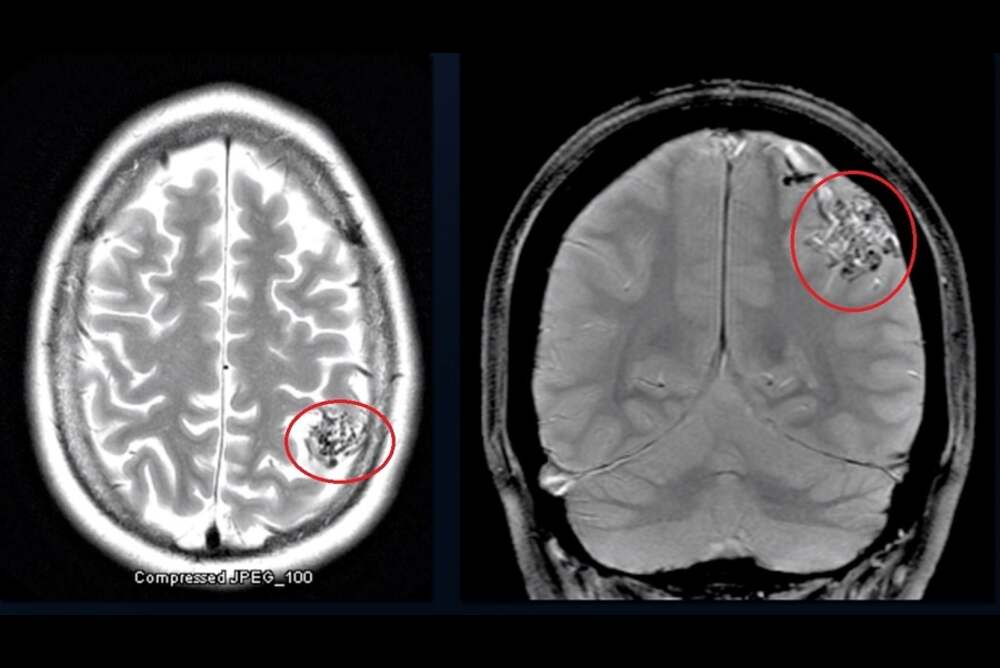 Treatment Options for Brain AVM