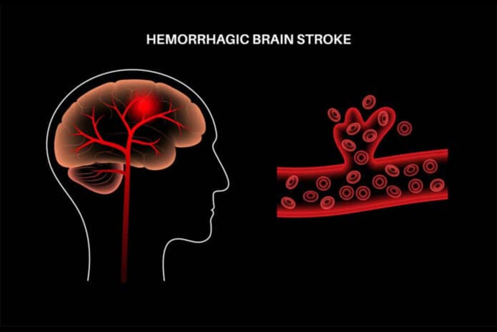 Types of Brain Hemorrhage
