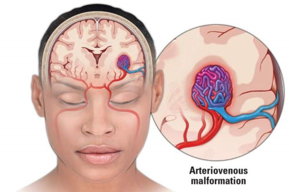 What is a Brain AVM