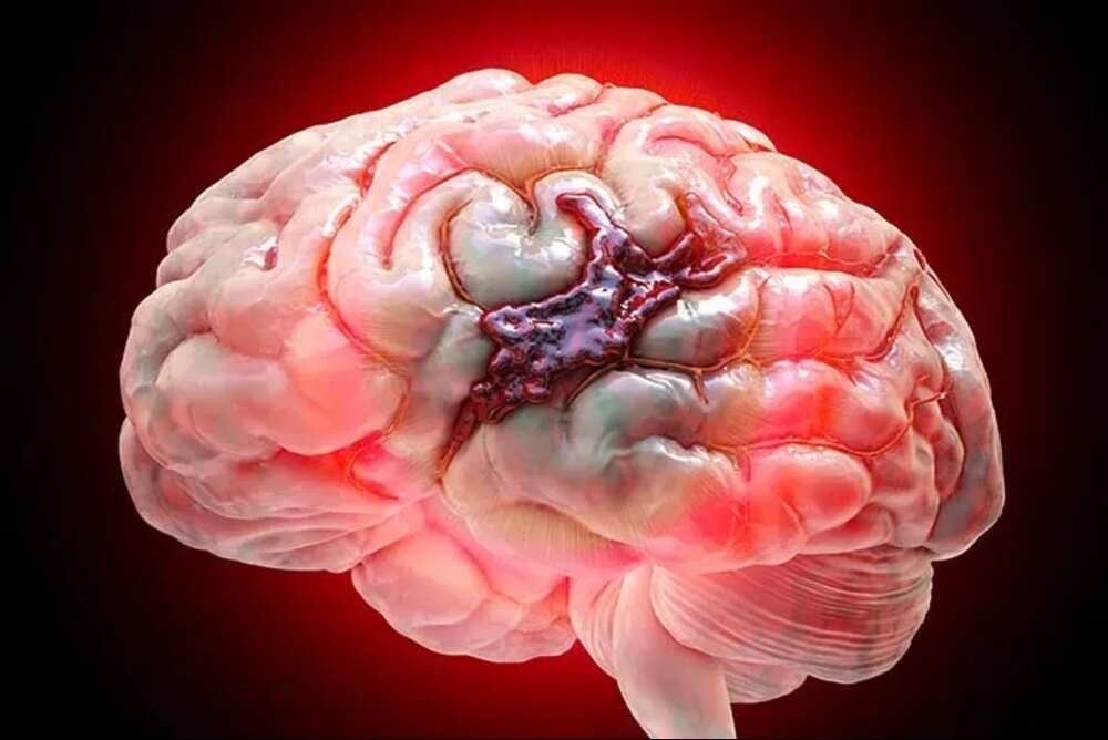 What is a Brain Hemorrhage