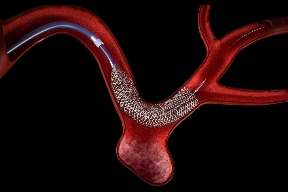 What is a Flow Diverter