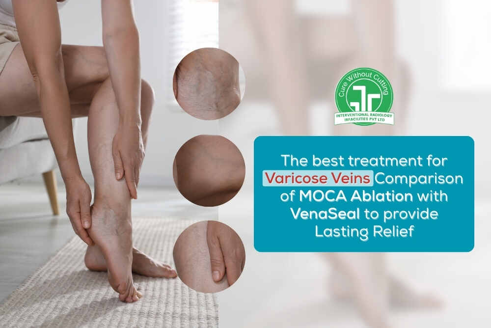 The best treatment for Varicose Veins Comparison of MOCA Ablation with VenaSeal to provide Lasting Relief