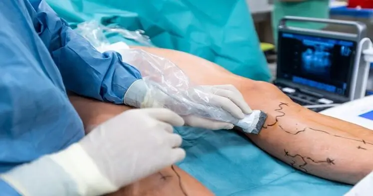 Laser treatment for leg veins