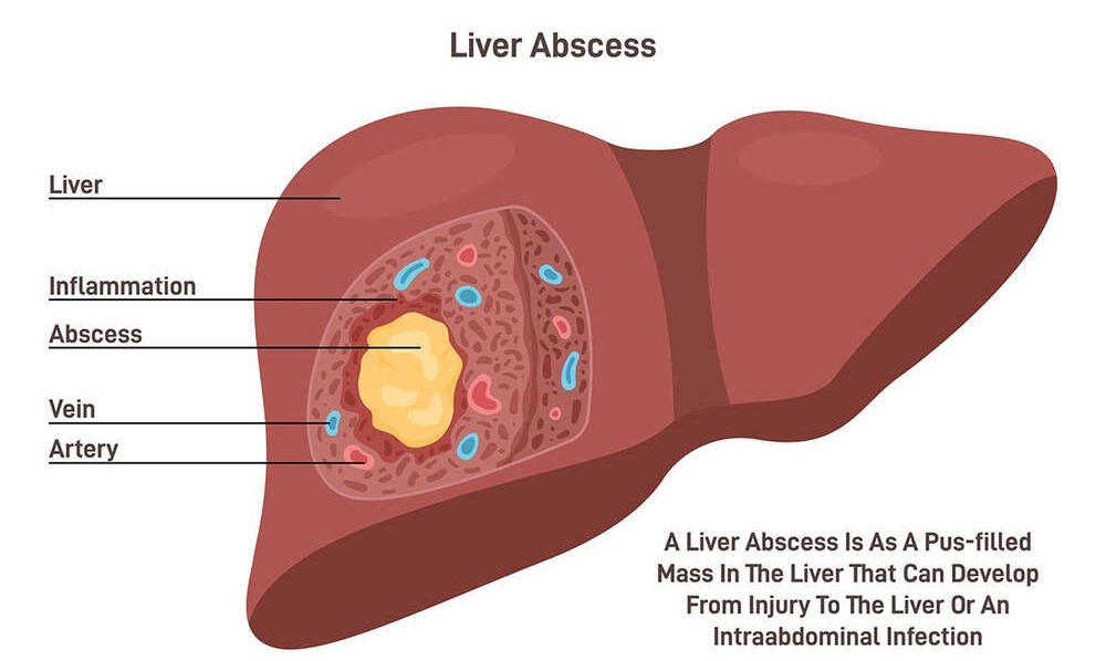 Causes Diagnosis of Liver Abscess