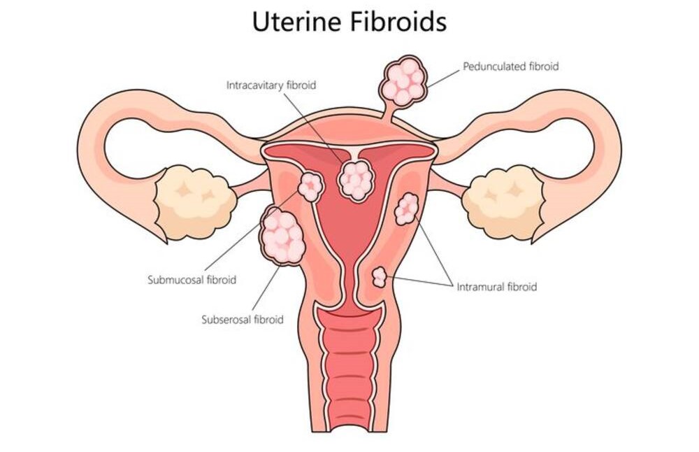 Causes of Uterine Fibroids
