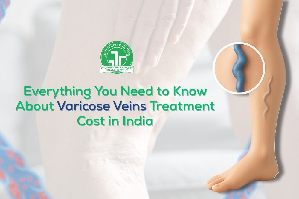 Everything You Need to Know About Varicose Veins Treatment Costs in India