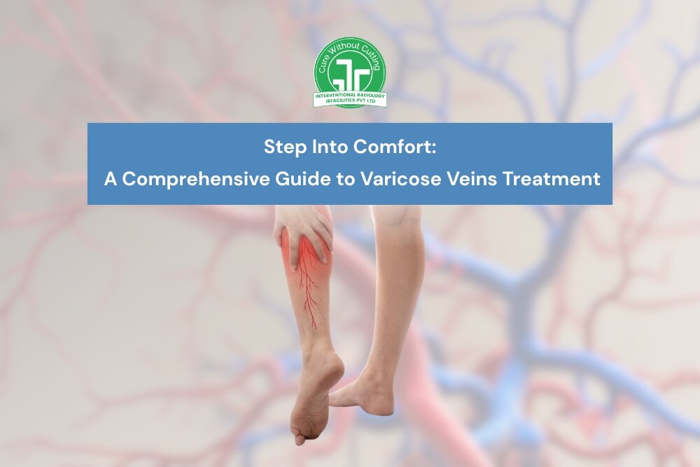 Step Into Comfort A Comprehensive Guide to Varicose Veins Treatment