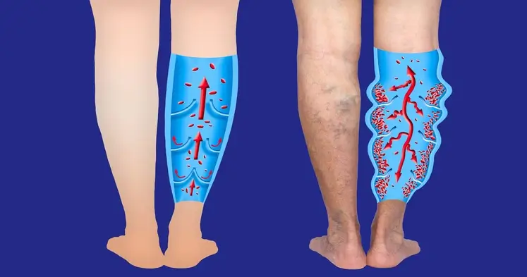 Comparison of normal and varicose veins in the legs.