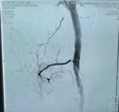 Inferior lateral genicular artery