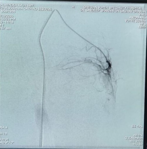 Inferior medial genicular artery
