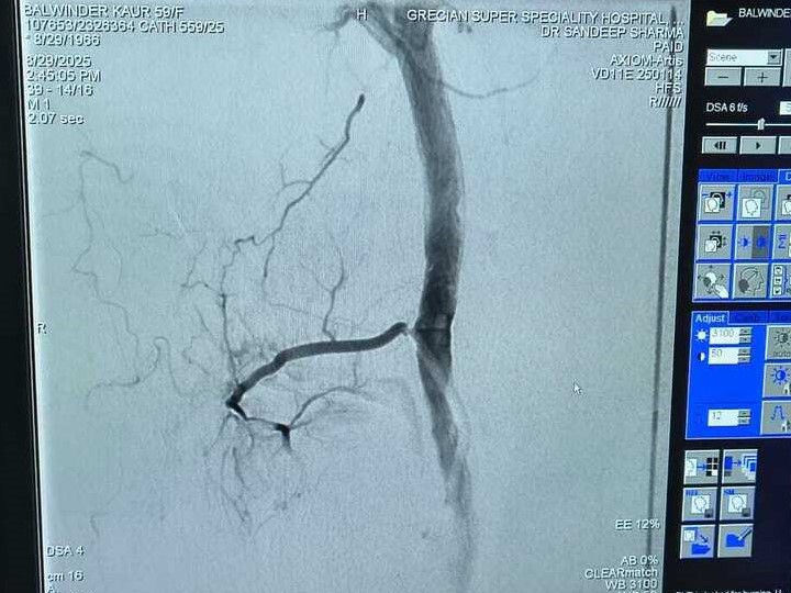Inferior lateral genicular artery